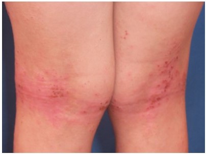 Atopic Dermatitis.jpg